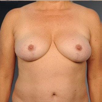 Steven Teitelbaum, MD breast reduction after — Santa Monica, CA