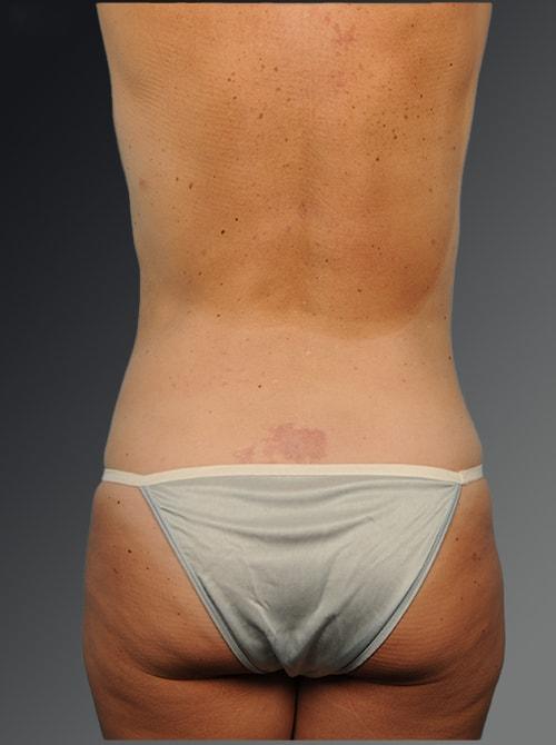 Steven Teitelbaum, MD liposuction after — Santa Monica, CA