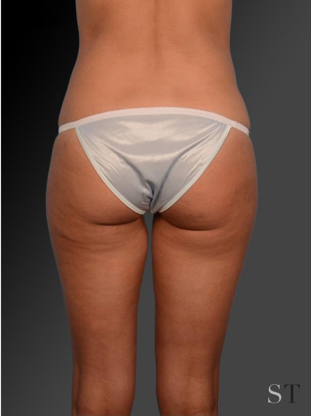 Liposuction after at Steven Teitelbaum, MD in Santa Monica, CA