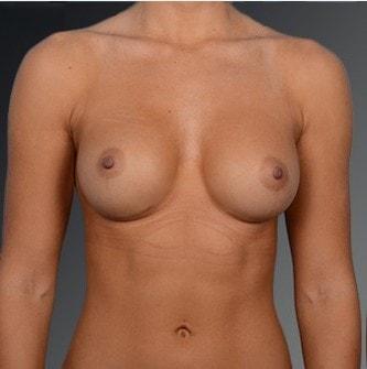 Fat Transfer Breast Augmentation after at Steven Teitelbaum, MD in Santa Monica, CA
