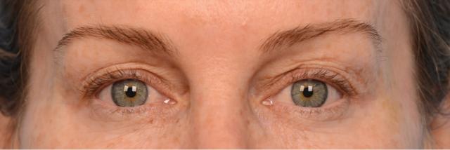 Blepharoplasty before at Steven Teitelbaum, MD in Santa Monica, CA