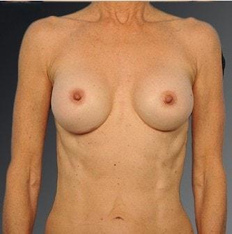 Fat Transfer Breast Augmentation after at Steven Teitelbaum, MD in Santa Monica, CA