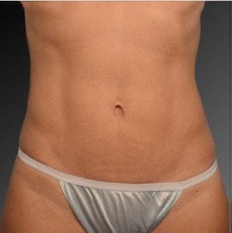 Liposuction after at Steven Teitelbaum, MD in Santa Monica, CA