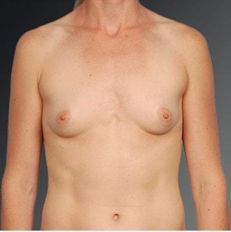 Fat Transfer Breast Augmentation before at Steven Teitelbaum, MD in Santa Monica, CA