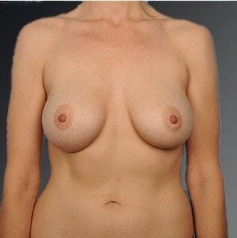 Fat Transfer Breast Augmentation after at Steven Teitelbaum, MD in Santa Monica, CA