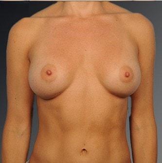 Fat Transfer Breast Augmentation after at Steven Teitelbaum, MD in Santa Monica, CA
