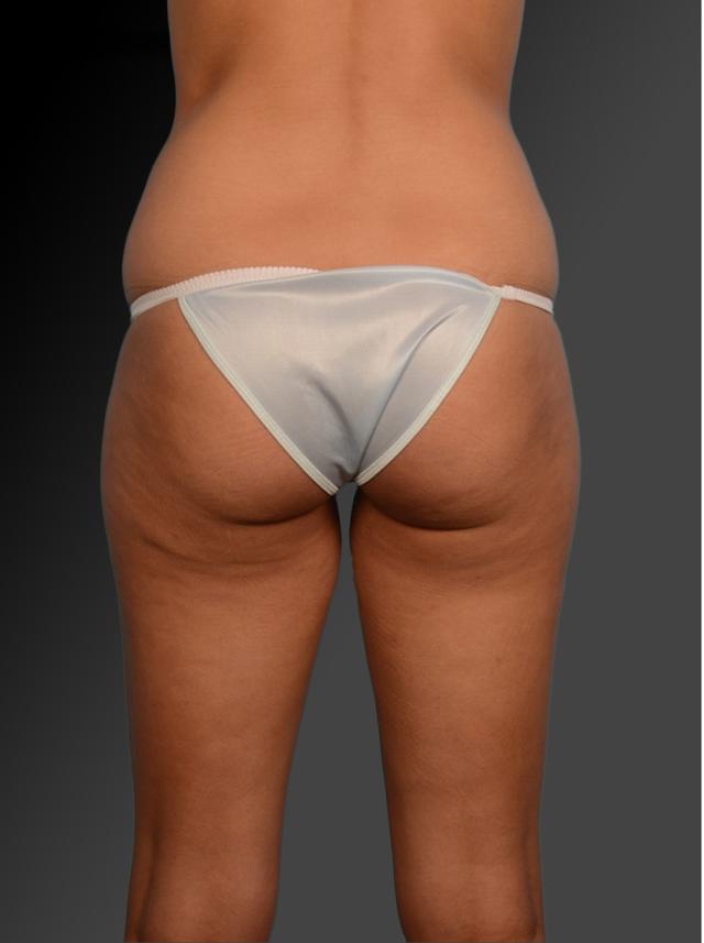 Liposuction before at Steven Teitelbaum, MD in Santa Monica, CA