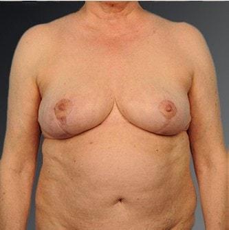 Steven Teitelbaum, MD breast reduction after — Santa Monica, CA