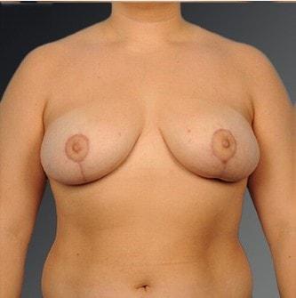Steven Teitelbaum, MD breast reduction after — Santa Monica, CA