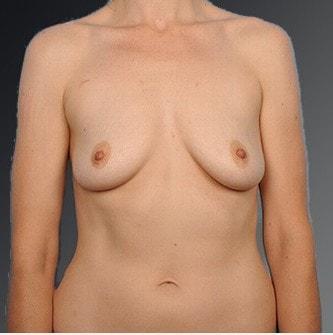 Fat Transfer Breast Augmentation before at Steven Teitelbaum, MD in Santa Monica, CA