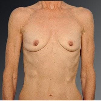 Fat Transfer Breast Augmentation before at Steven Teitelbaum, MD in Santa Monica, CA