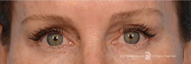 Blepharoplasty after at Steven Teitelbaum, MD in Santa Monica, CA