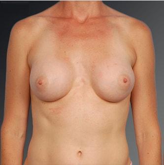 Fat Transfer Breast Augmentation after at Steven Teitelbaum, MD in Santa Monica, CA