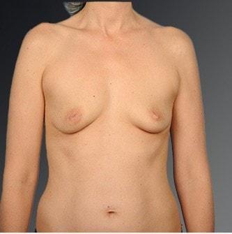 Fat Transfer Breast Augmentation before at Steven Teitelbaum, MD in Santa Monica, CA