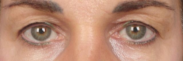 Blepharoplasty before at Steven Teitelbaum, MD in Santa Monica, CA
