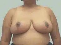 Perimeter Plastic Surgery breast reduction after — Atlanta, GA