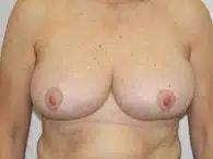 Perimeter Plastic Surgery breast reduction after โ Atlanta, GA