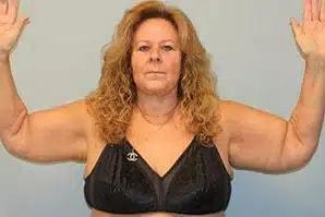 Arm Lift after at Perimeter Plastic Surgery in Atlanta, GA