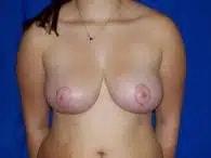 Perimeter Plastic Surgery breast reduction after โ Atlanta, GA