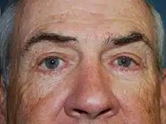 Perimeter Plastic Surgery eyelid lift after โ Atlanta, GA
