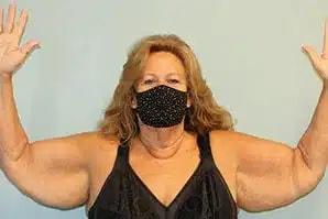 Arm Lift before at Perimeter Plastic Surgery in Atlanta, GA