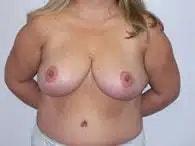 Perimeter Plastic Surgery breast reduction after โ Atlanta, GA