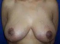 Perimeter Plastic Surgery breast reduction after โ Atlanta, GA