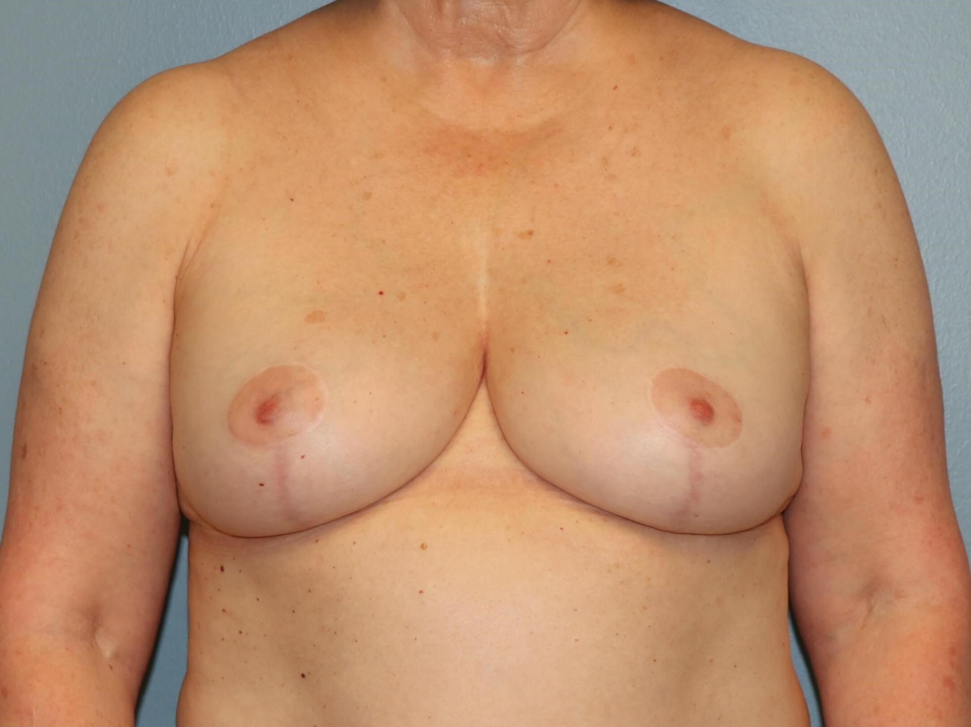 Albright Plastic Surgery breast augmentation revision after — Shenandoah, TX