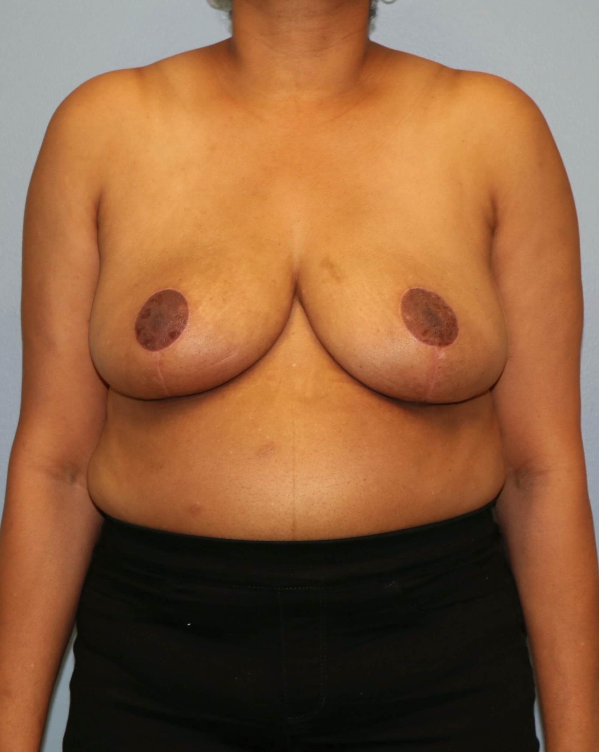 Albright Plastic Surgery breast reduction after — Shenandoah, TX