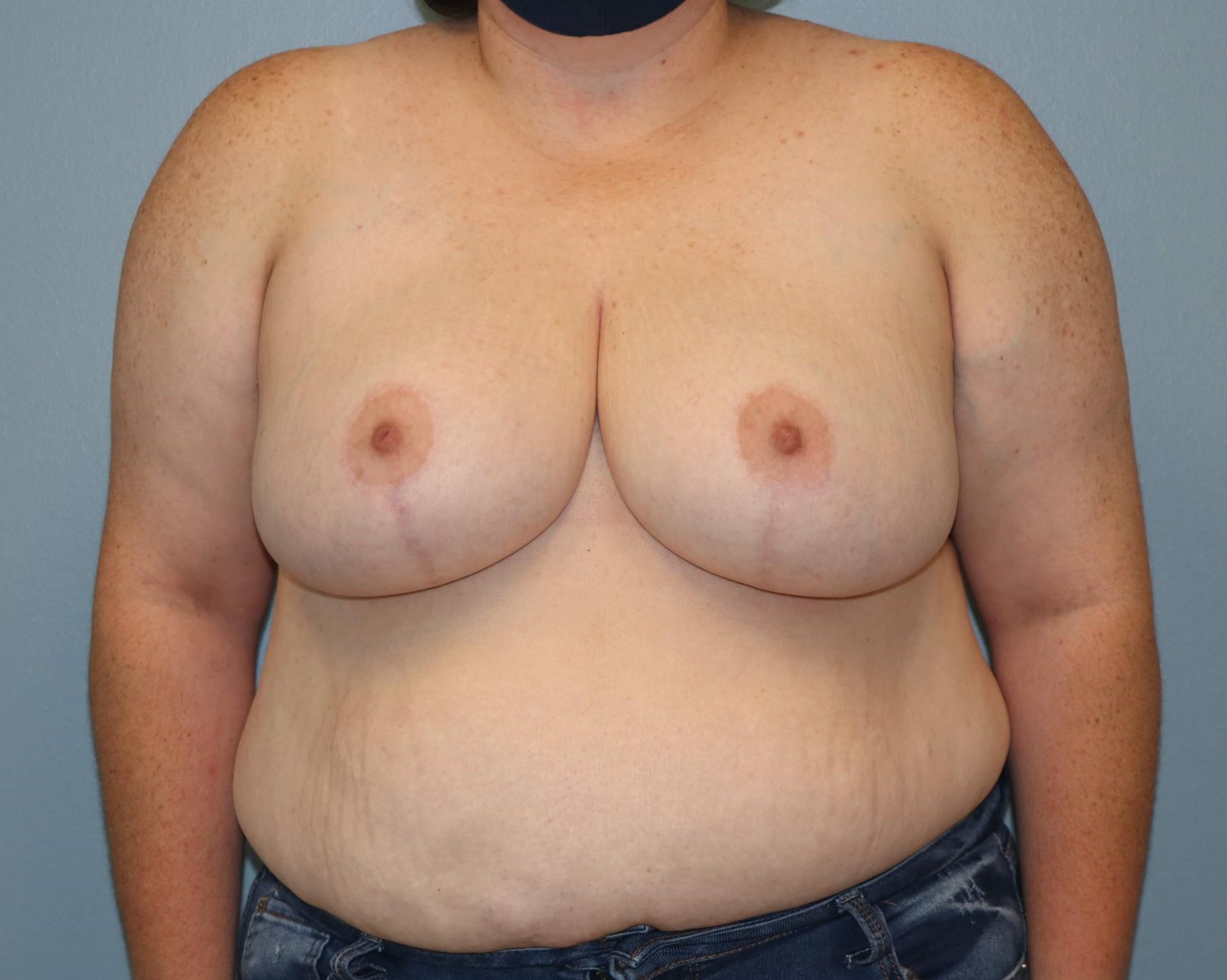 Albright Plastic Surgery breast reduction after — Shenandoah, TX