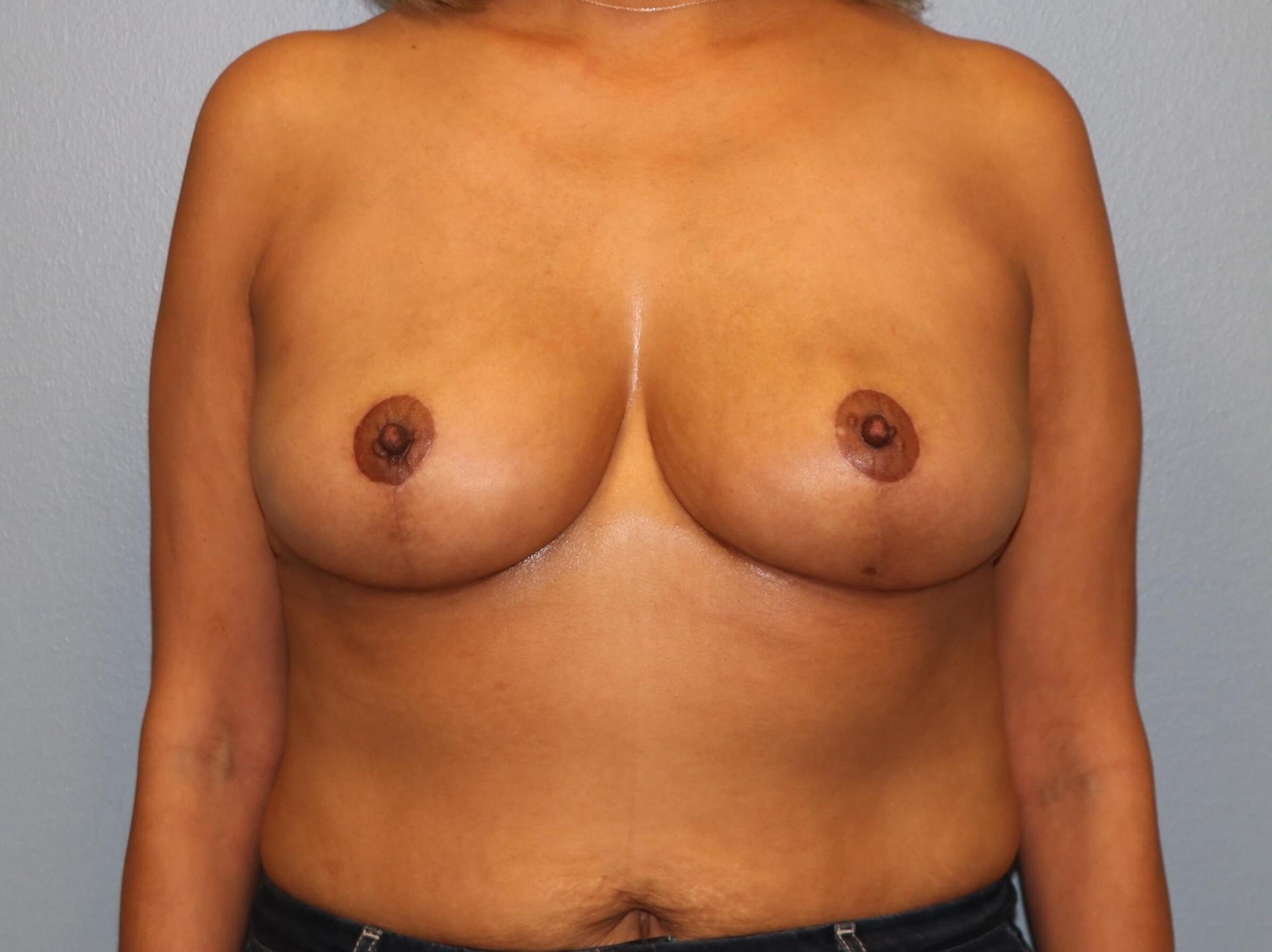 Albright Plastic Surgery breast reduction after — Shenandoah, TX