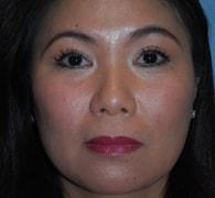Eric Okamoto, MD eyelid lift after — Fremont, CA