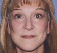 Eric Okamoto, MD facelift after — Fremont, CA