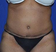 Eric Okamoto, MD tummy tuck after — Fremont, CA