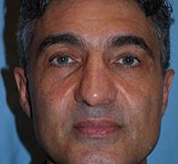 Eric Okamoto, MD rhinoplasty after — Fremont, CA