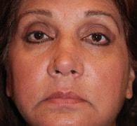 Eric Okamoto, MD rhinoplasty after — Fremont, CA
