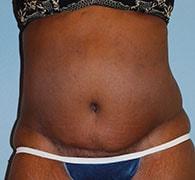 Eric Okamoto, MD tummy tuck after — Fremont, CA