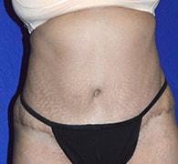 Eric Okamoto, MD tummy tuck after — Fremont, CA