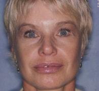 Eric Okamoto, MD facelift after — Fremont, CA
