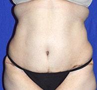 Eric Okamoto, MD tummy tuck after — Fremont, CA