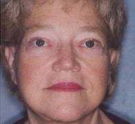 Eric Okamoto, MD facelift after — Fremont, CA
