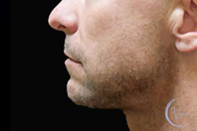 Chin Implant after at Verve Plastic Surgery in Encinitas, CA
