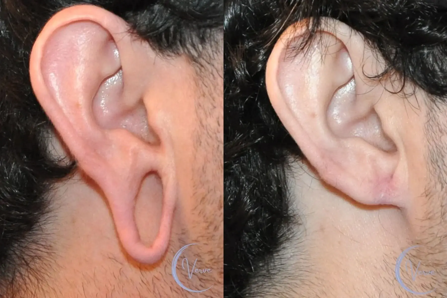 Verve Plastic Surgery otoplasty result — Encinitas, CA