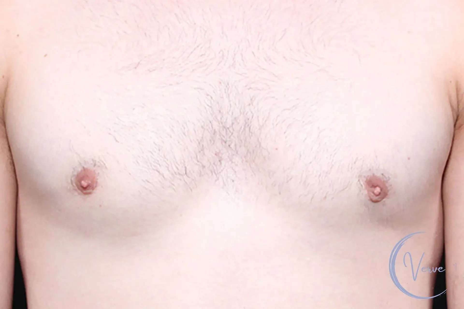 Verve Plastic Surgery gynecomastia after — Encinitas, CA