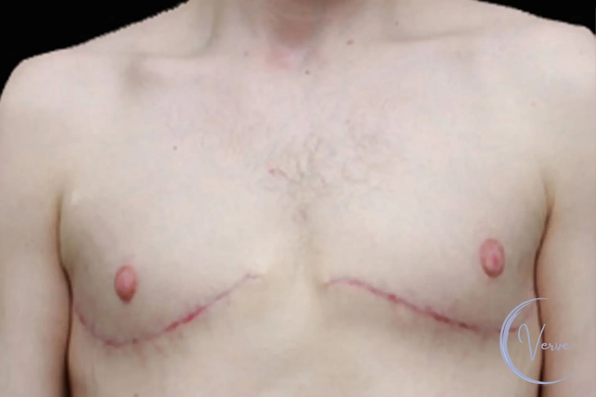 Verve Plastic Surgery gynecomastia after — Encinitas, CA