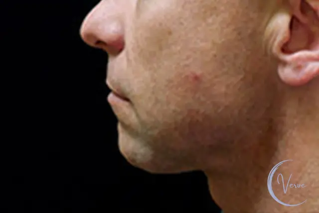 Chin Implant before at Verve Plastic Surgery in Encinitas, CA