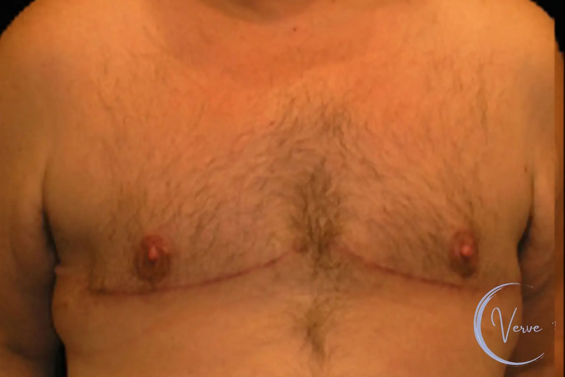 Verve Plastic Surgery gynecomastia after — Encinitas, CA