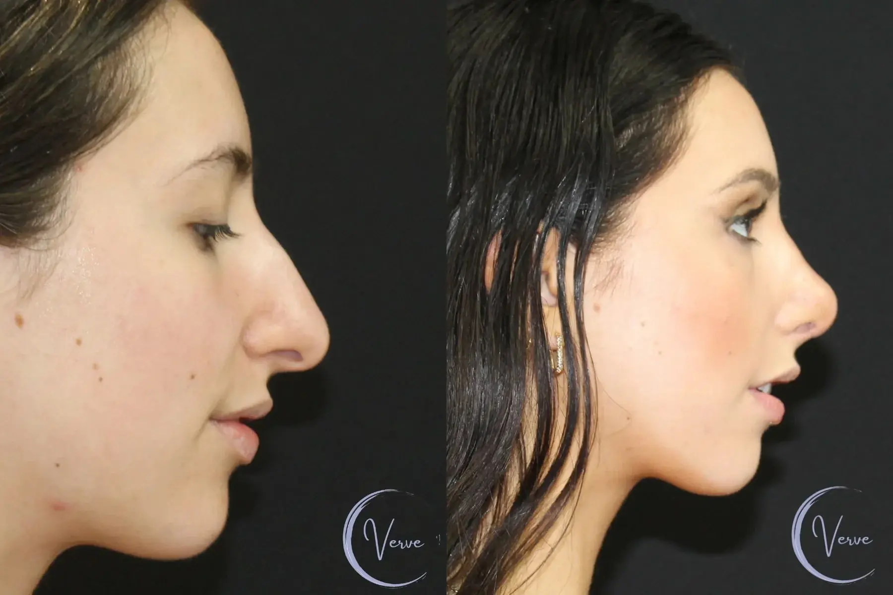 Verve Plastic Surgery rhinoplasty result — Encinitas, CA