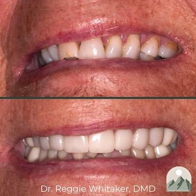 Roy Dental Care smile makeover result — Roy, UT