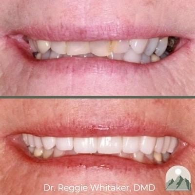 Roy Dental Care veneers result — Roy, UT